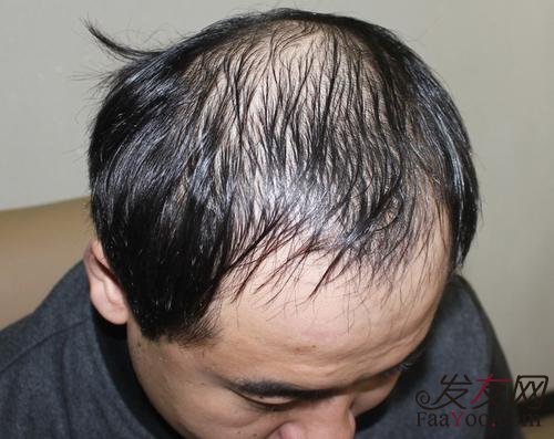 脂溢性脱发怎样才能治好?