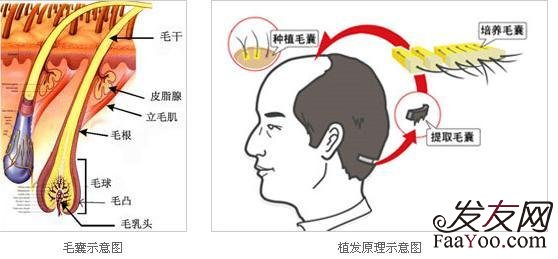 为什么有些人不能植发?