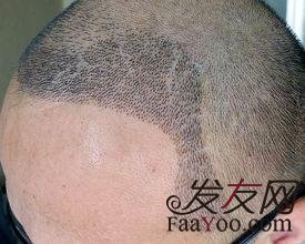 植发后的头发是怎么生长的?