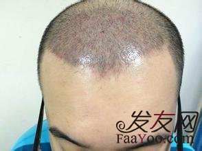 植发后的头发是怎么生长的?