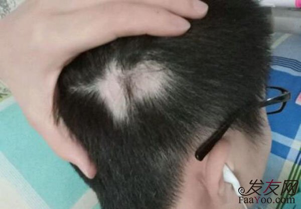 哪几种人不适合植发呢?