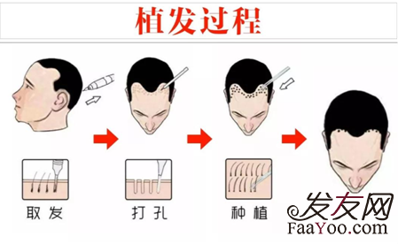 什么决定着植发的价格?