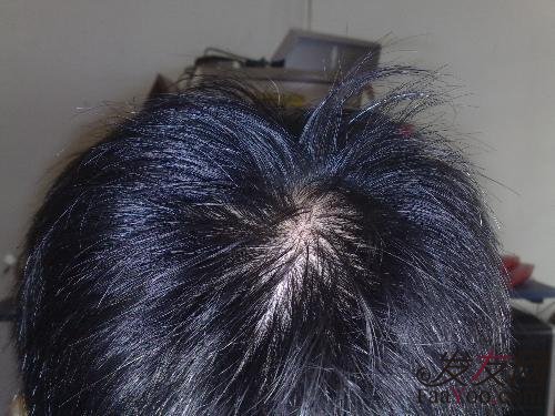 脂溢性脱发怎么正确洗头呢?