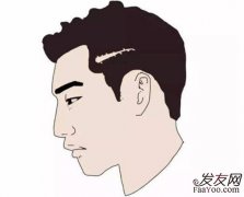 为什么那么多人去植发？