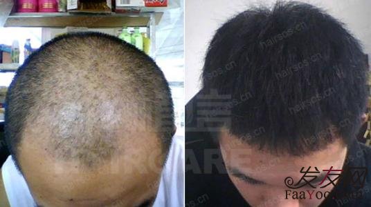 毛发种植禁忌有哪些?