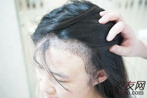 植发后几天能洗头?