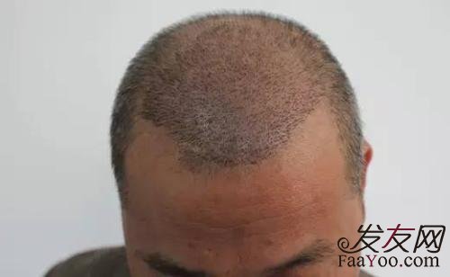 植发后几天能洗头?