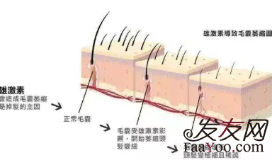 影响植发的因素都有什么?