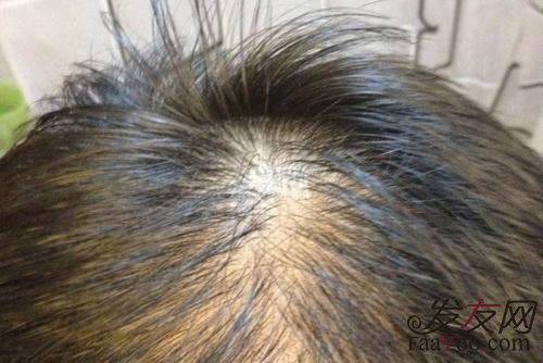 掉发的原因到底是什么?