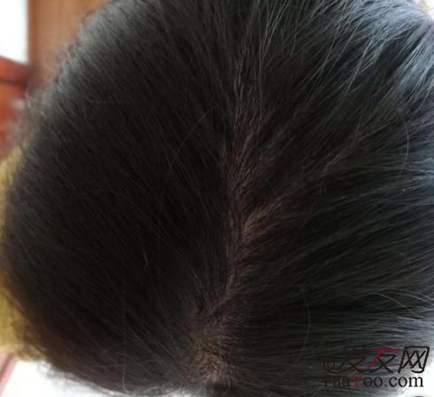 脂溢性脱发有哪些表现特征？