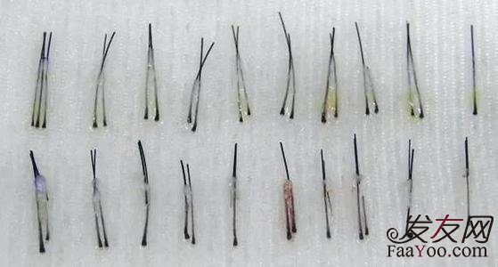 植发后还会不会脱发呢?