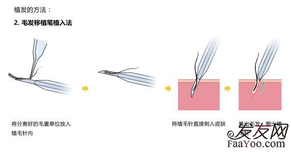 怎样才能避免植发后遗症发生?