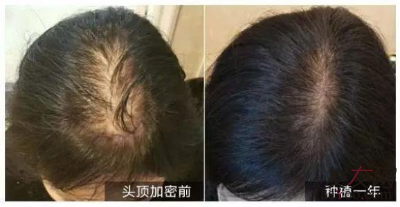 植发可以做加密吗?