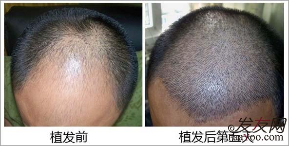 植发的风险是不是很大?