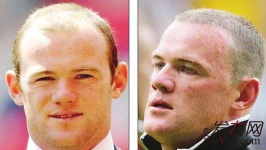 很多明星为什么不去植发?