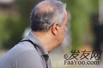 一般脱发原因和那些因素有关?