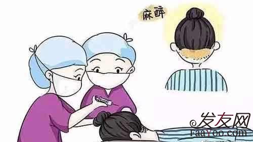 植发具体过程是怎样的?