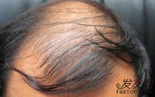 地中海可以去做植发手术吗?