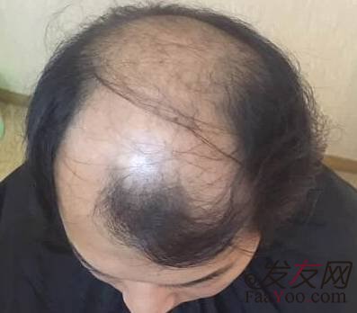 地中海可以去做植发手术吗?