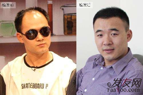 地中海可以去做植发手术吗?