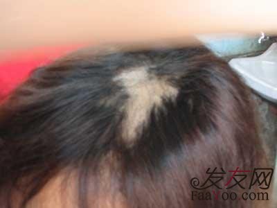 脱发为何越来越趋向年轻化了?