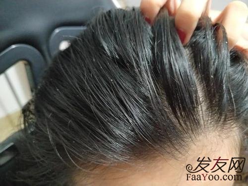 脱发为何越来越趋向年轻化了?