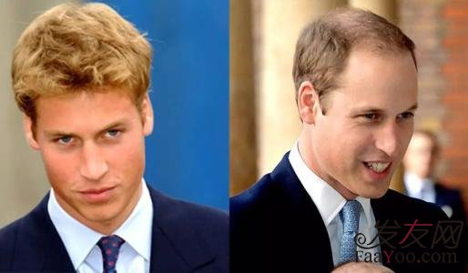 植发后的脱落期大概需要多长时间?