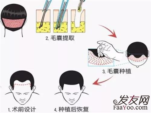 植发的时候会感到疼吗?