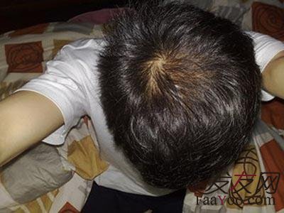 哪些可以说是治疗脱发最好的办法呢?