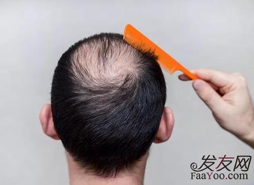 男性脱发了还可以治疗好吗？