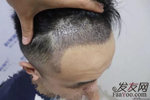 毛囊不足了该怎么办?