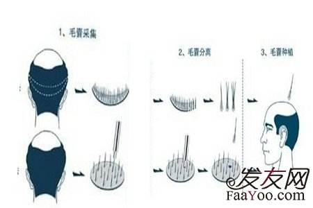 植发手术会很痛苦吗?