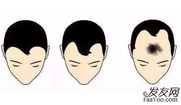 男性额角脱发了该怎么生发？
