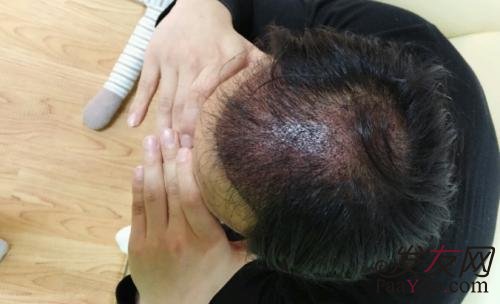 一般毛发移植需要多长时间?