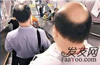 遗传一般多少岁的时候会秃顶呢?