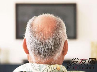 遗传一般多少岁的时候会秃顶呢?