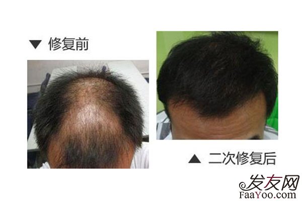 植发失败了应该怎么办?