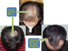  脂溢性脱发何时能做植发手术？
