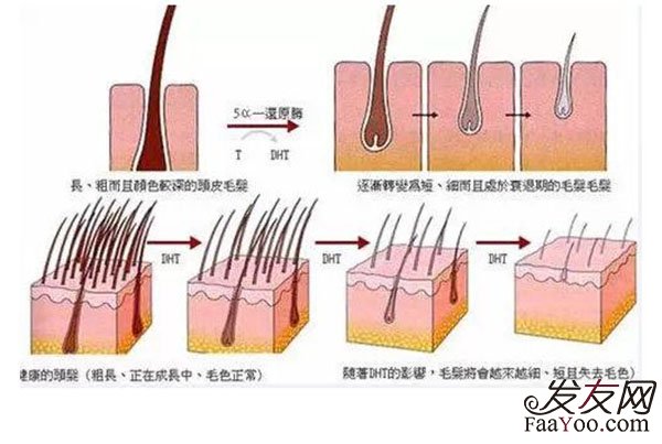 脂溢性脱发何时能做植发手术？