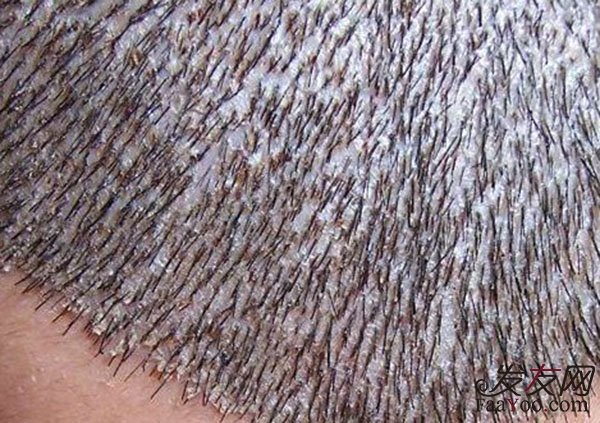头发稀疏的话可以去做植发手术吗？