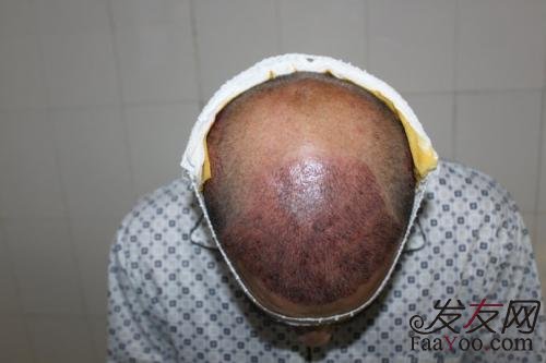 植发价格和哪几方面有关?