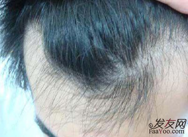 青少年应该怎么防止脱发?
