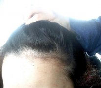 脱发的时候可以去植发吗