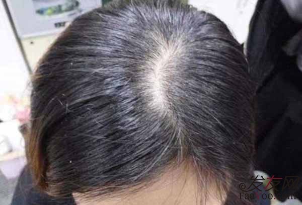 脂溢性脱发较好几天洗一次头?