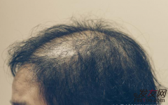 生姜和芝麻一起吃可以预防脱发吗？