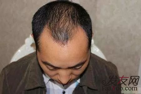 男性出现发际线上移正常吗?