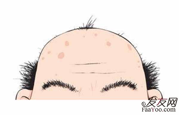 男性出现发际线上移正常吗?