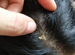 螨虫导致的脱发应该如何处理？