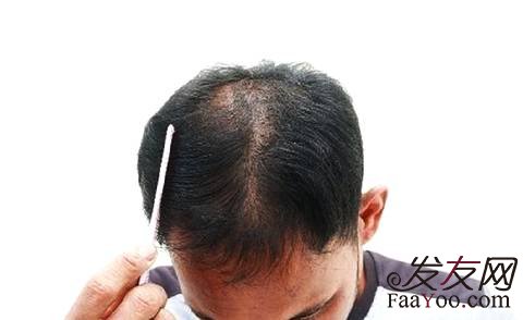 毛发移植区取发区怎么护理？