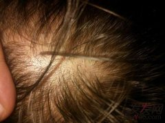 肾虚性脱发能自愈吗？